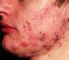 Blackheads.jpg