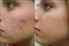 black heads.jpg