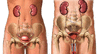 uti.gif