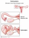 24437-hydrosalpinx.jpg